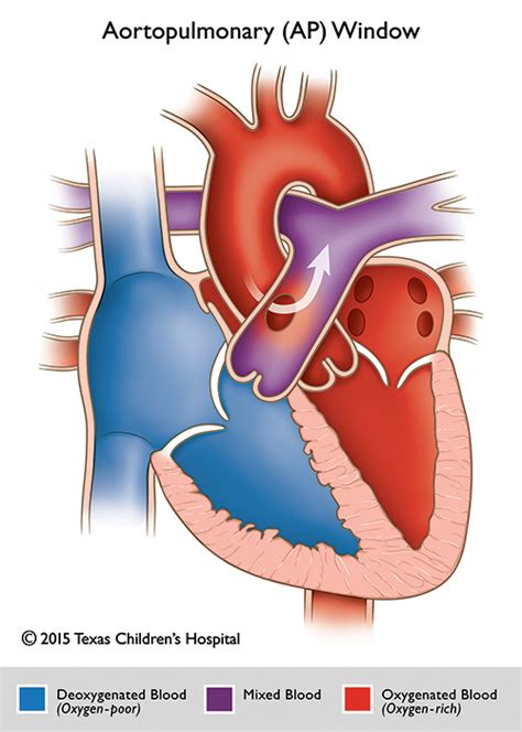 ap window aorta.